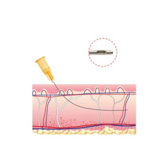 Cánula de relleno facial Aqulift Natural-Fill 26G x 50mm (20 piezas) para procedimientos cómodos y seguros-Leer más